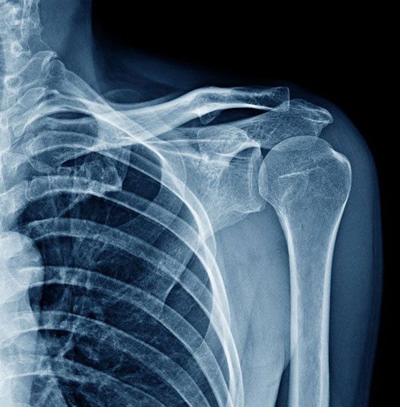 Types of Fractures